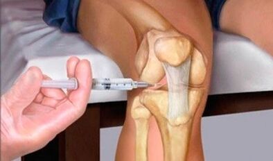 Ácido hialurónico con artrosis da articulación do xeonllo