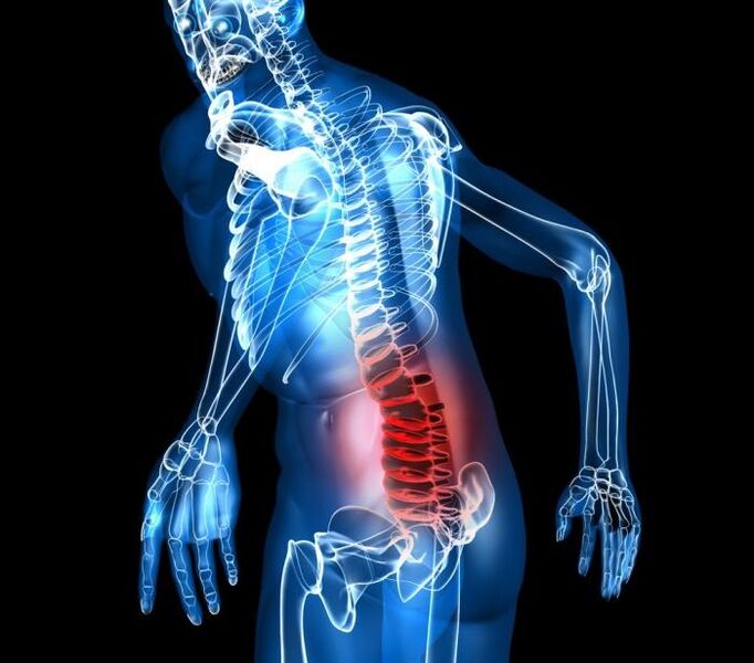 Fases de grao e desenvolvemento da osteocondrose lumbar