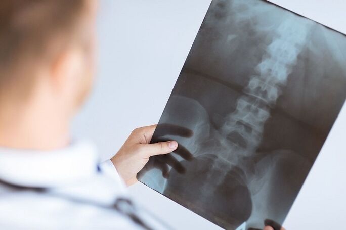 Opcións de diagnóstico para osteocondrosis lumbar
