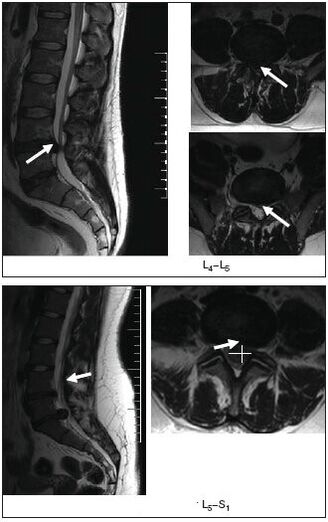 Imaxe de resonancia magnética dun disco herniado na columna vertebral