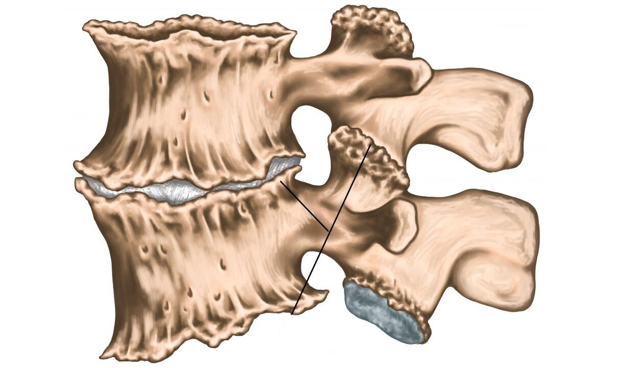 Lesións da columna vertebral por osteocondrose