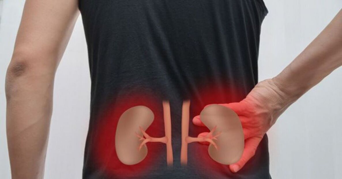 A inflamación dos riles pode causar dor lumbar