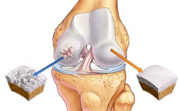 Osteoartrite da articulación do xeonllo (esquerda) e cartilaxe normal (dereita)