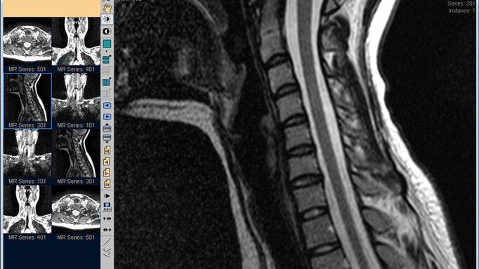 A resonancia magnética da columna cervical é o mellor método para diagnosticar a dor no pescozo